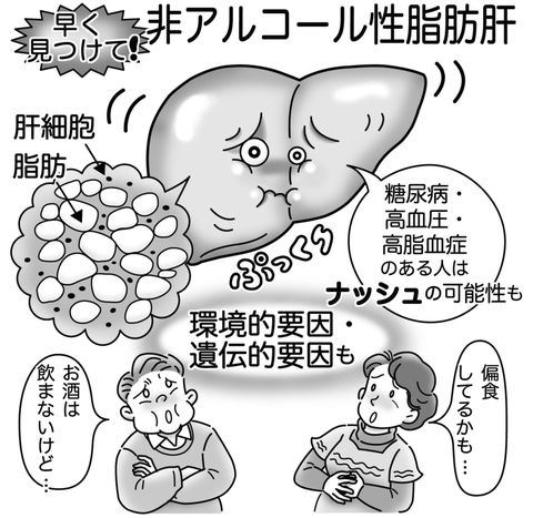 気になる症状 すっきり診断 ７４ 酒を飲まないのに脂肪肝 放置すればがん発症も 河北新報オンラインニュース Online News