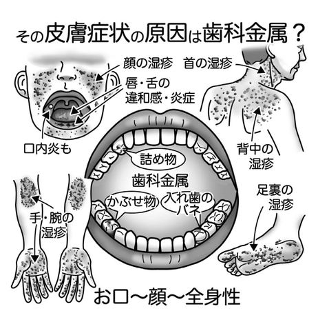 気になる症状 すっきり診断 ７５ 歯科金属アレルギー 症状は口内や全身にも 河北新報オンラインニュース Online News