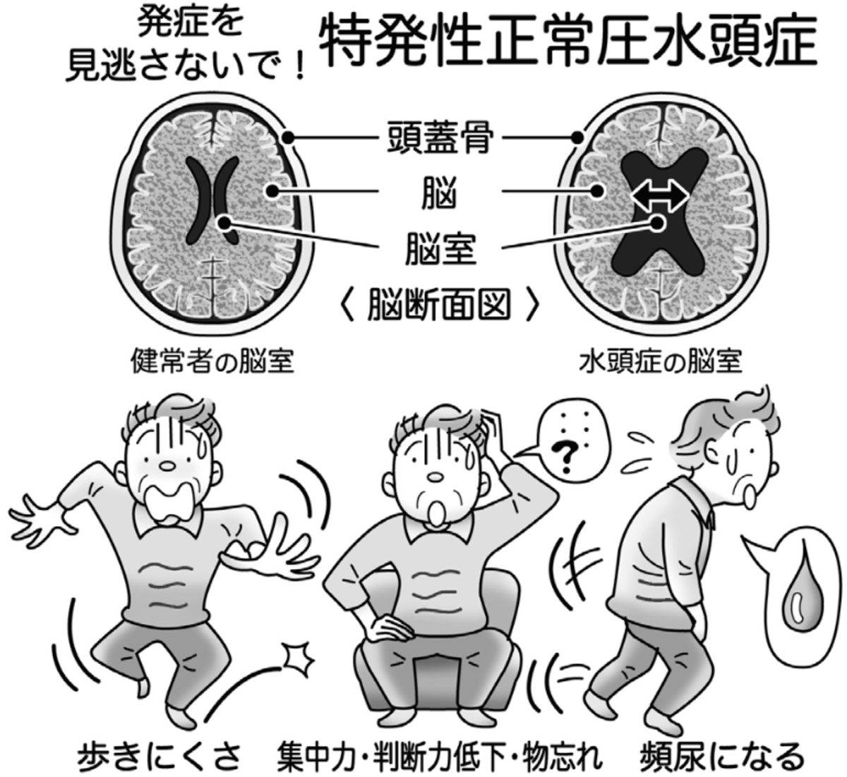 気になる症状 すっきり診断 ８２ 認知症誘因する特発性正常圧水頭症 脳の髄液手術で減らす 河北新報オンラインニュース Online News