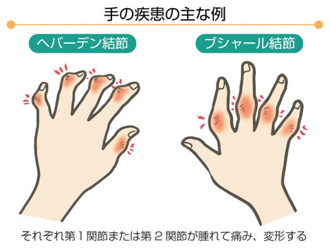 手の指の痛み、更年期症状かも | 河北新報オンラインニュース / ONLINE NEWS