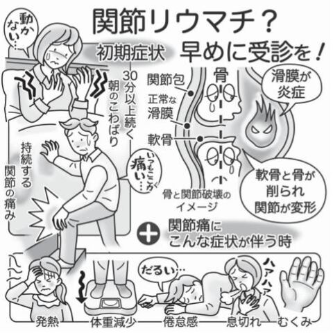 気になる症状 すっきり診断 １０１ 免疫異常で起こる関節リウマチ 早い新薬使用 進行抑制 河北新報オンラインニュース Online News