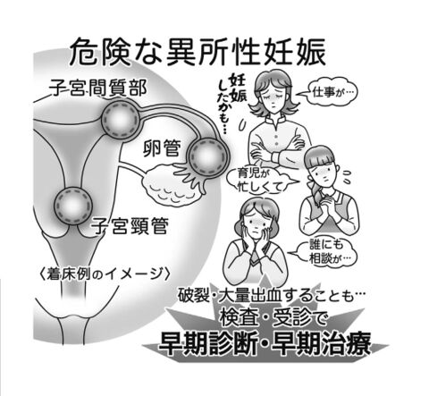 気になる症状 すっきり診断 １１１ 子宮外に着床する異所性妊娠 母体死亡も 早期受診を 河北新報オンラインニュース Online News