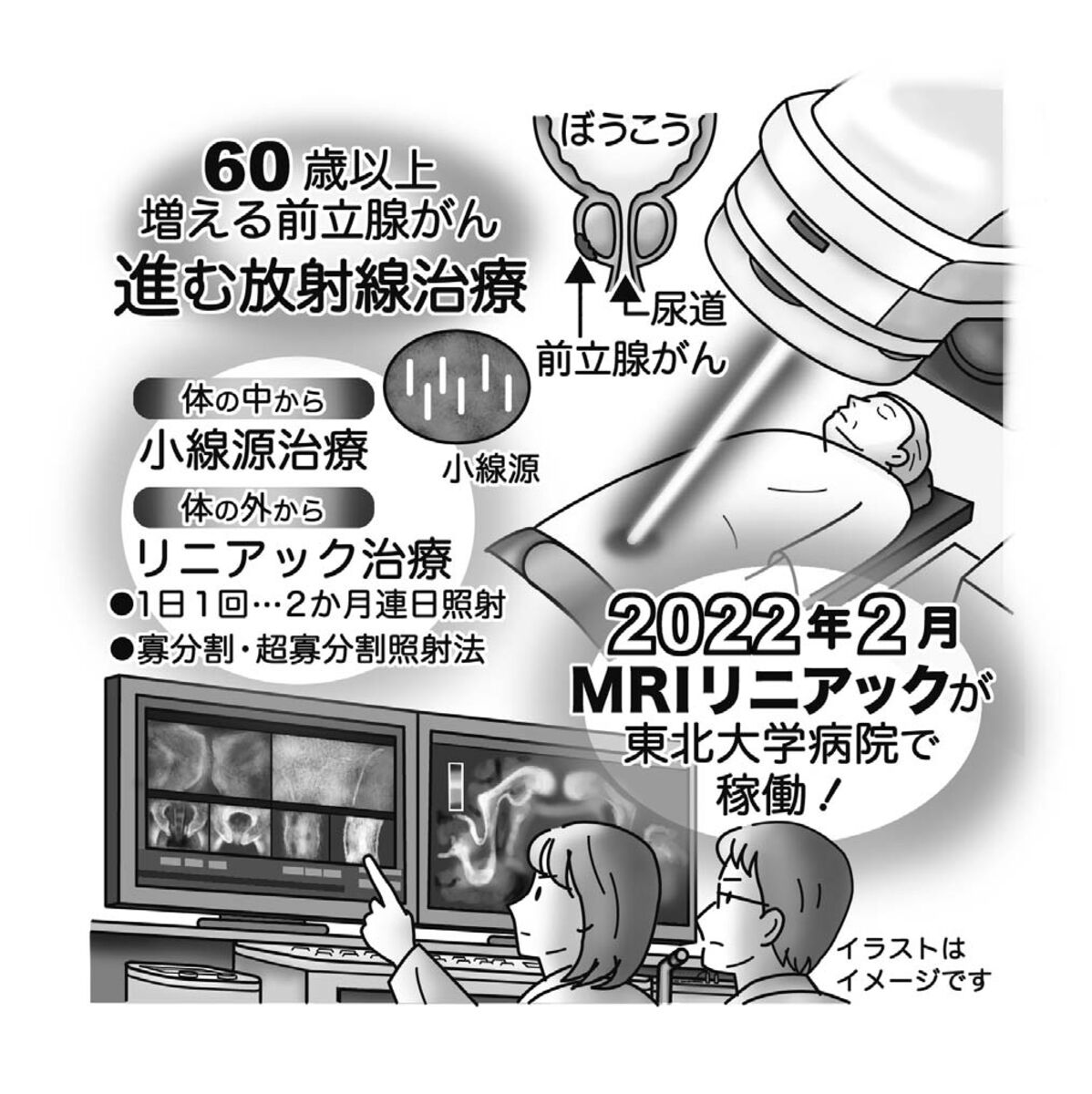 気になる症状 すっきり診断 １１５ 前立腺がんの放射線治療 線量 回数考え体外照射 河北新報オンラインニュース Online News