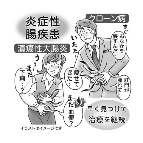 気になる症状 すっきり診断 １２２ 腹痛 下痢繰り返す炎症性腸疾患 がんリスク 血便に注意 河北新報オンラインニュース Online News