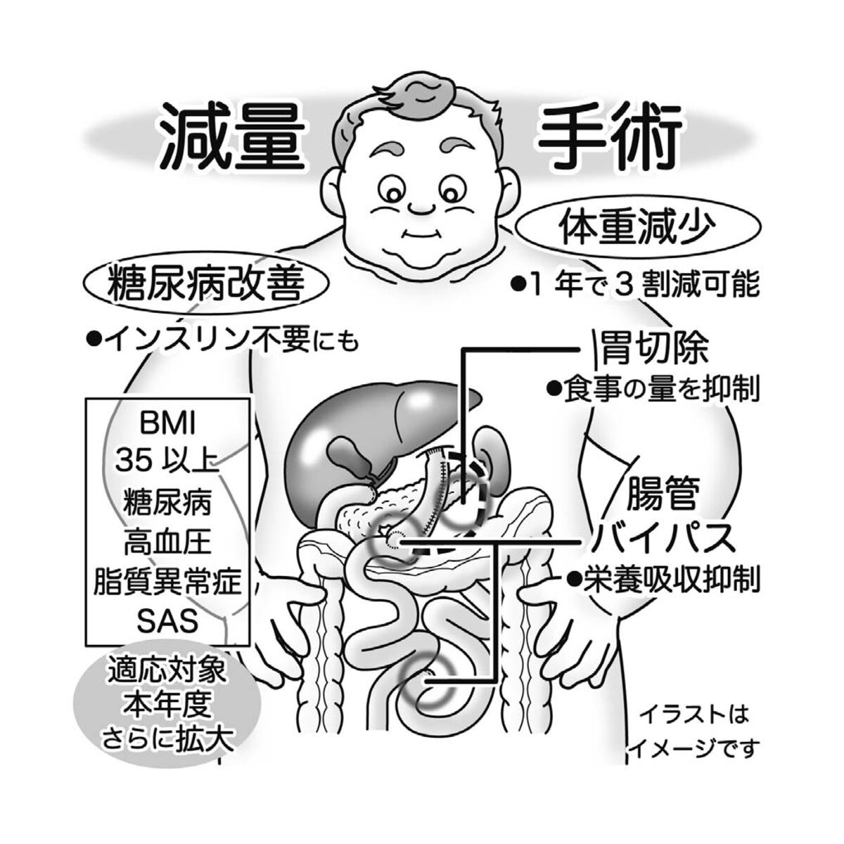 気になる症状 すっきり診断 １３０ 外科手術による肥満改善 糖尿病治療の選択肢に 河北新報オンラインニュース Online News